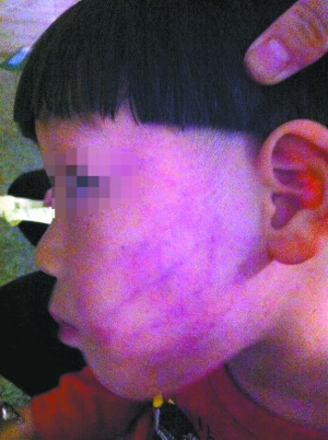 5岁孩遭老师狂扇耳光满面伤痕 家长欲殴老师(图)